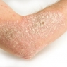 eczema