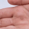 warts