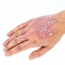 psoriasis