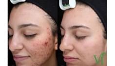 Acne before and after