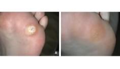 Foot wart