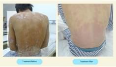 Psoriasis before and after