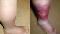 cellulitis