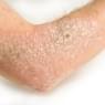 eczema
