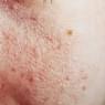 skin cancer